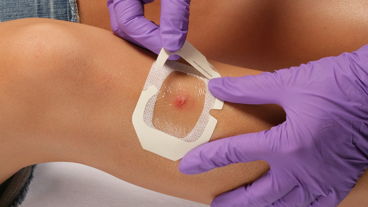 Engineering Advanced Wound Care Dressings for Modern Healthcare