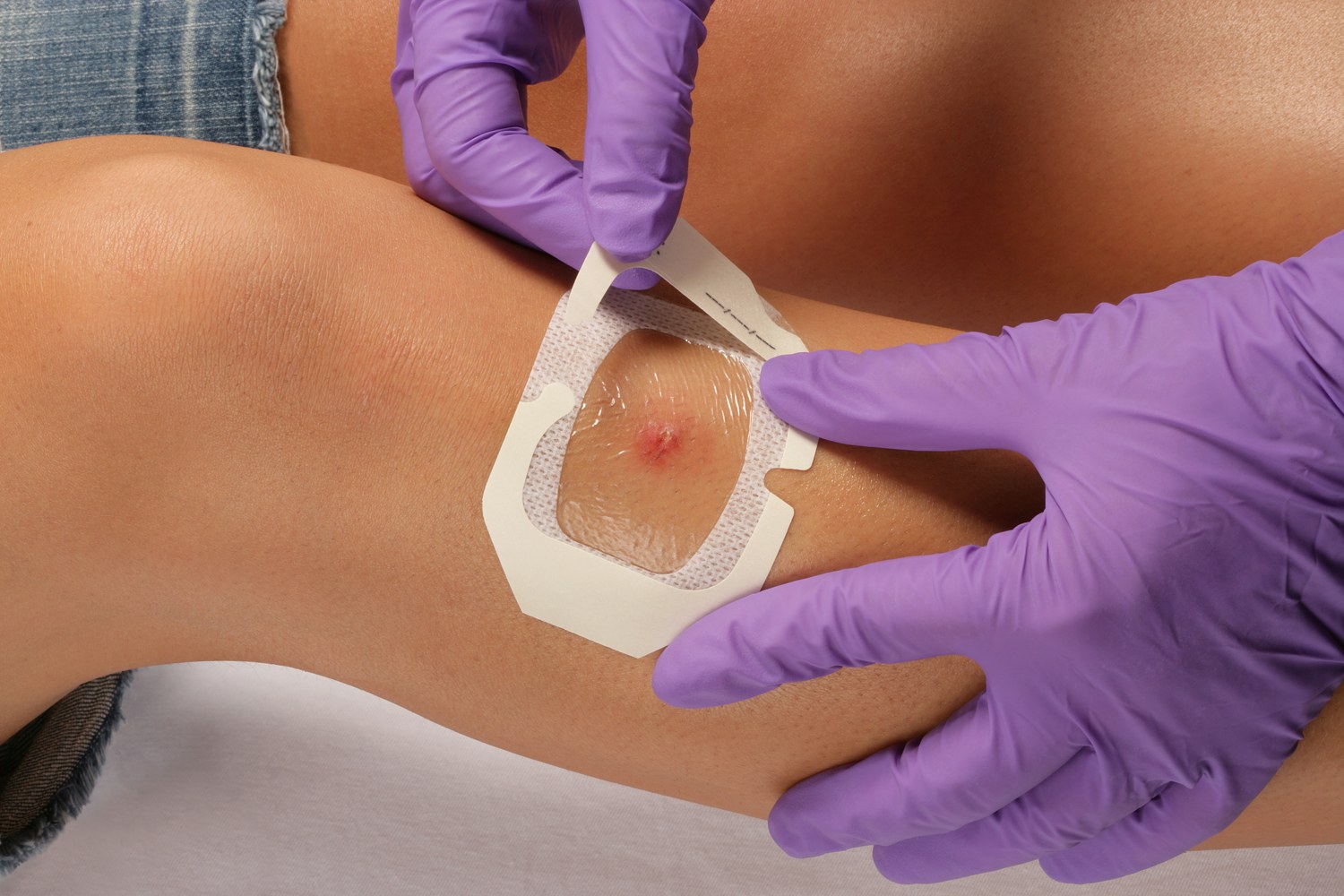 Engineering Advanced Wound Care Dressings for Modern Healthcare